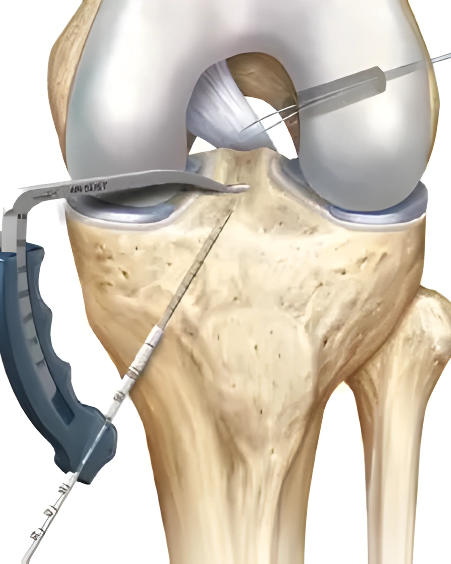 Dr Divya Bandari -   Ligament Repair and Reconstruction Specialist